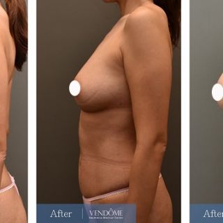 療程效果因人而異，上圖為D罩杯卻乳房下垂的女性在做完自體脂肪隆乳之後​手術後一個月、手術後八個月成效